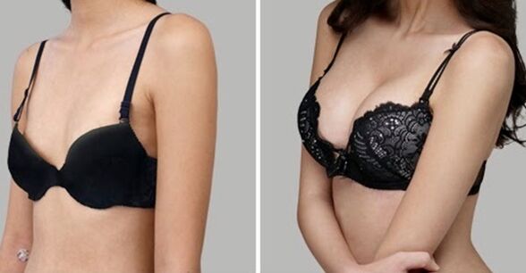 vor und nach Brustvergrößerung