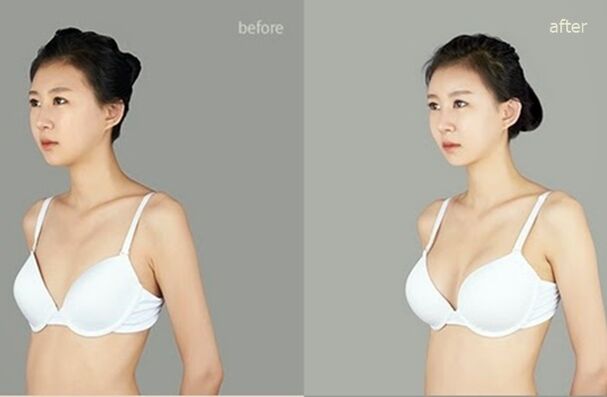 vor und nach plastischer Brustvergrößerung
