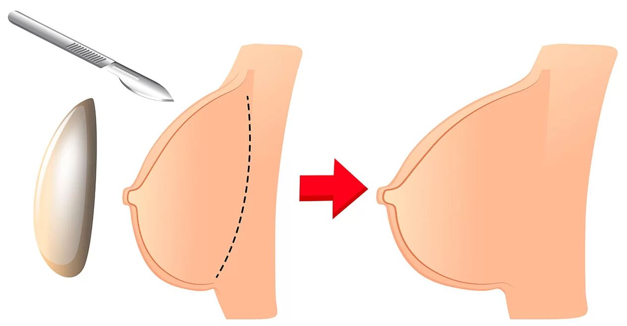 Brustvergrößerung mit einem Implantat