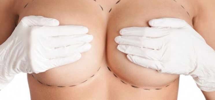 Brustvergrößerung durch Operation